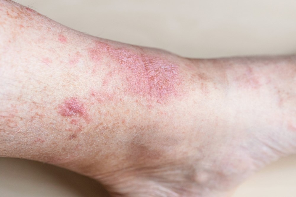 Na první pohled náhle vzniklé otoky připomínají alergickou reakci. Mohou se objevit na končetinách, v obličeji, ale i v oblasti břicha a způsobit bolesti, zvracení či průjem.