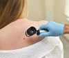 Květen je měsícem melanomu kůže. Častěji na něj umírají muži